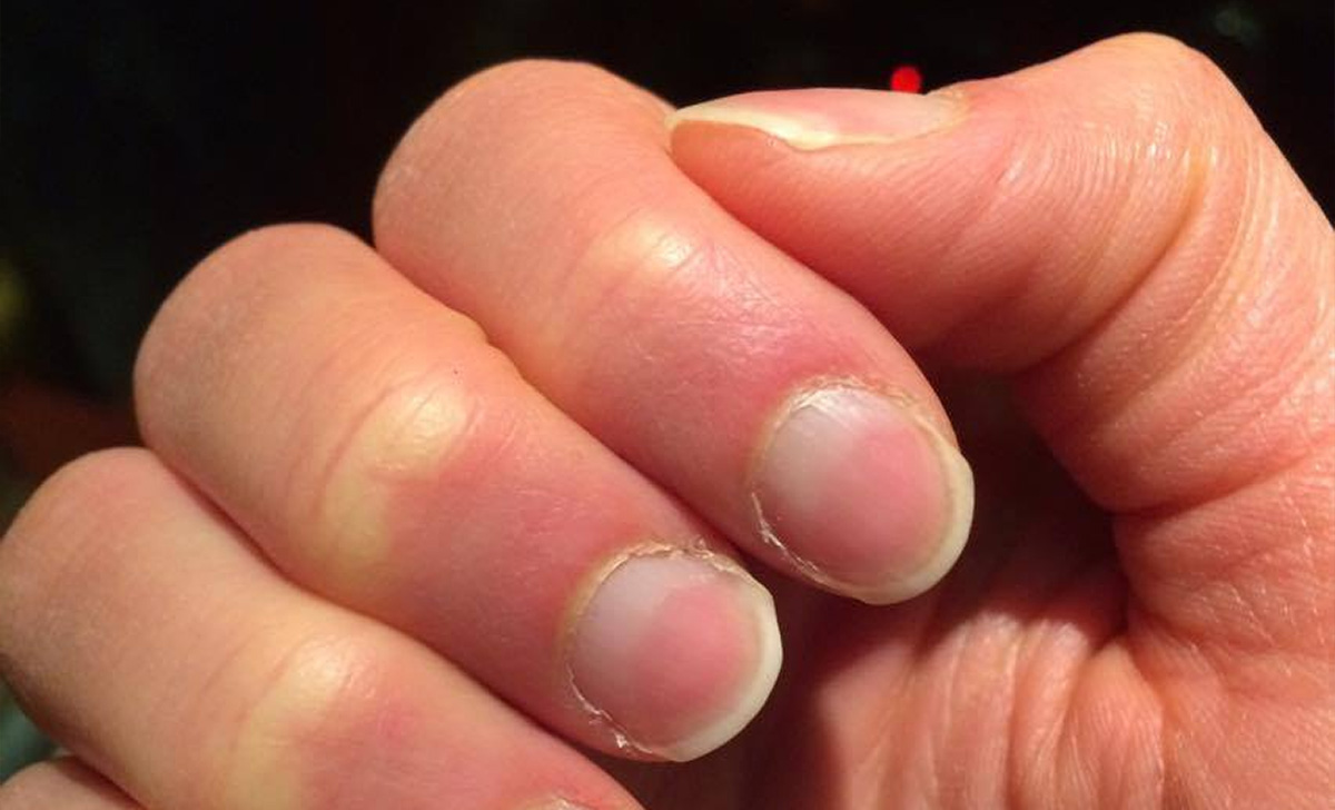 That is why the white streaks on the nails could be the alarm bell of
