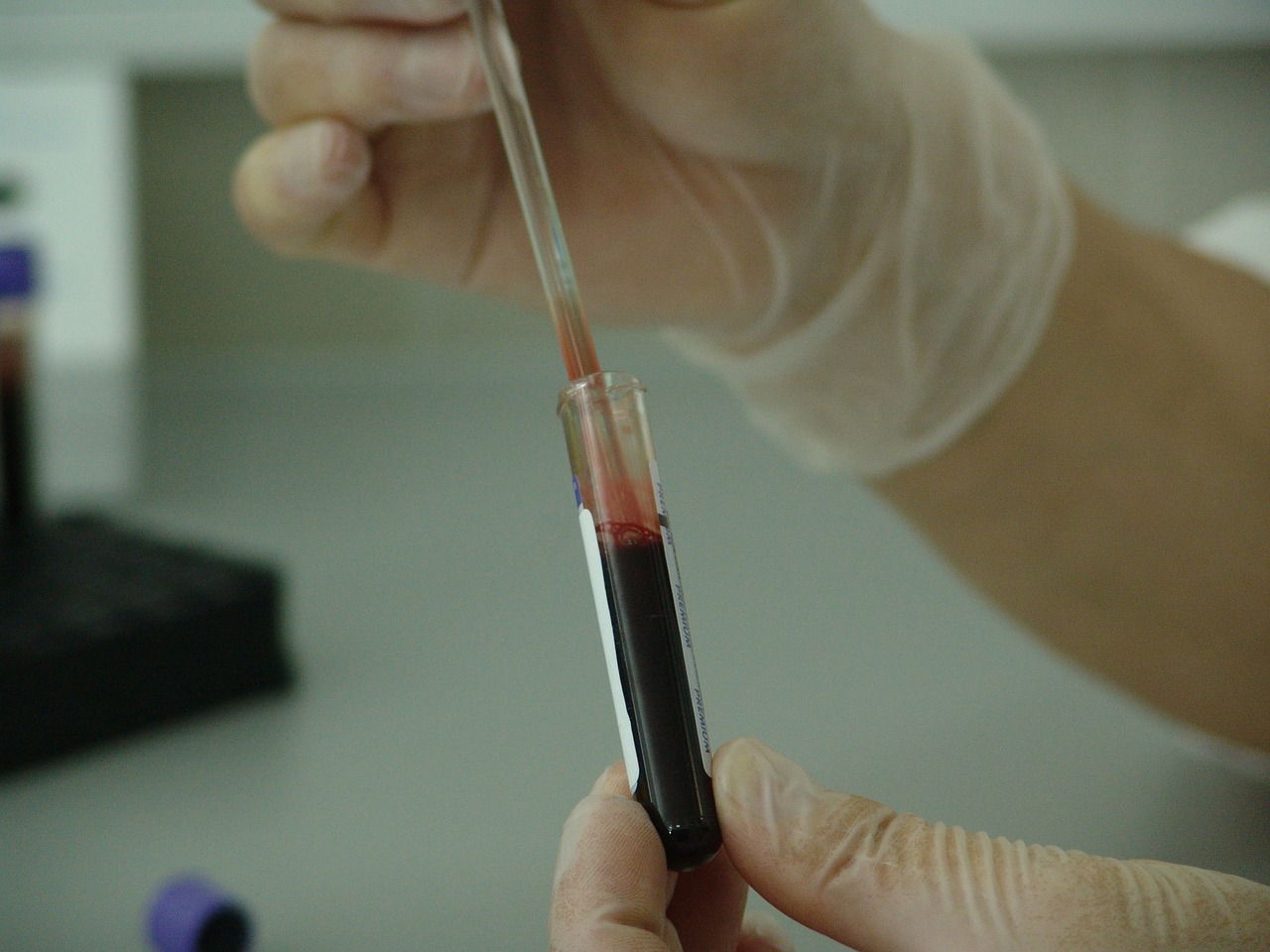 É por isso que ignorar este valor de teste de sangue pode causar problemas renais graves