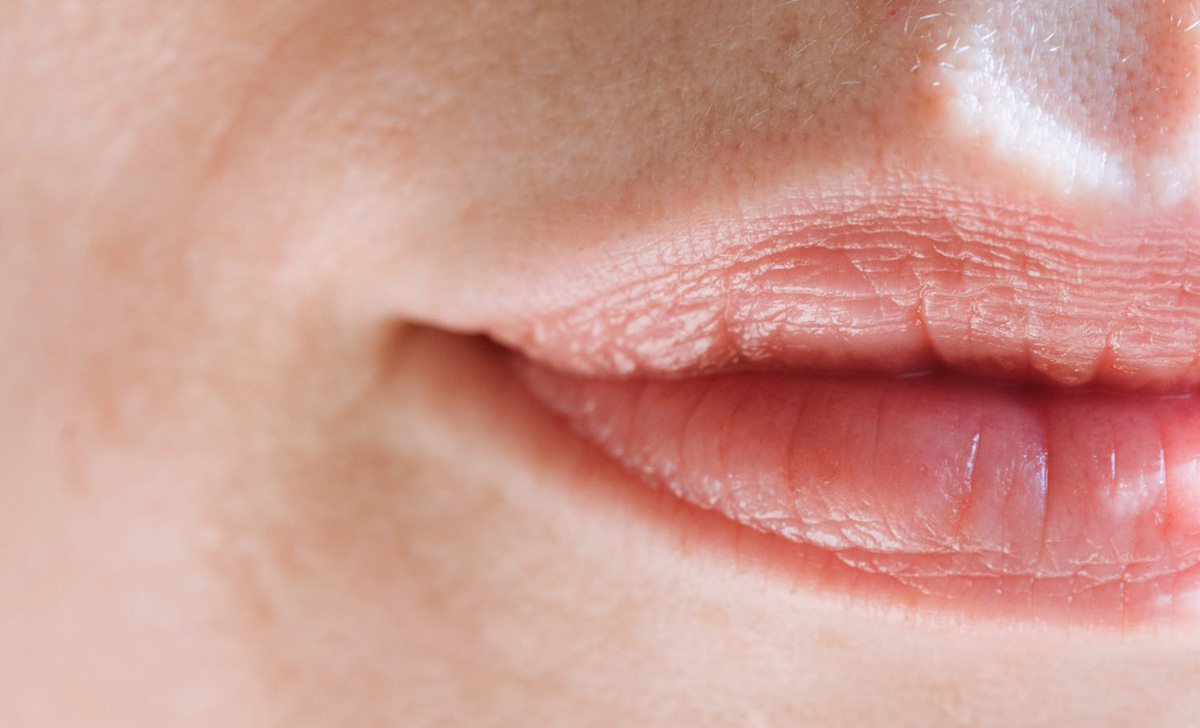 Prurito e pizzicore alle labbra potrebbero essere sintomi di questo virus ma attenzione perché colpisce anche i genitali